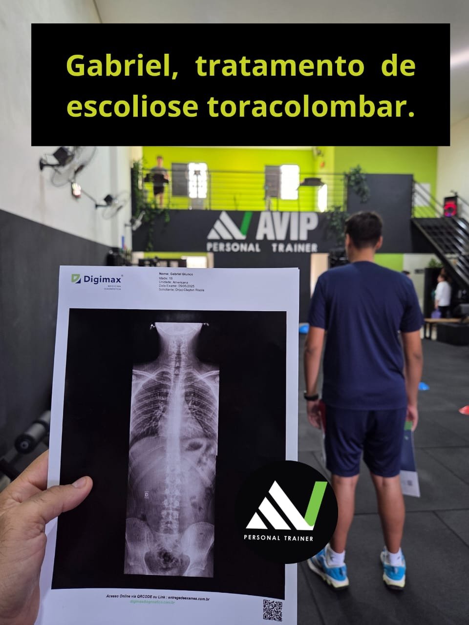 Case clínico — tratamento de escoliose toracolombar